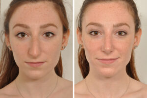 Balancing Symmetry and Naturalism in rhinoplasty