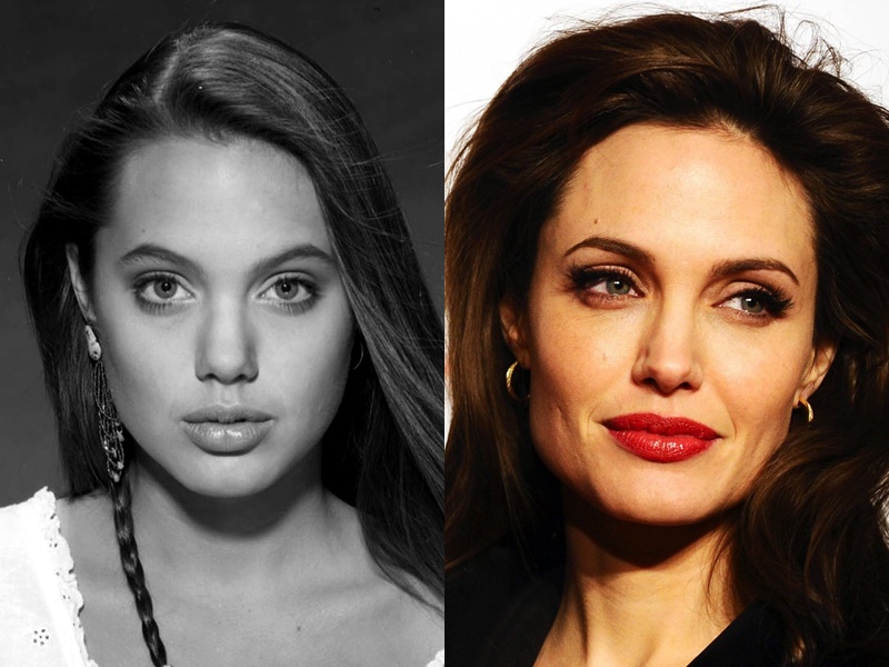 Mastering Angelina Jolie's Rhinoplasty Technique: An Art and Science